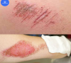 چگونه زخم پوستی را درمان کنیم