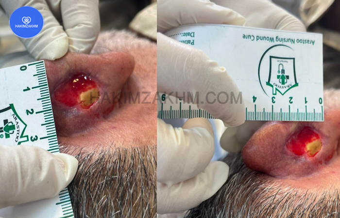 نمونه زخم انجام شده