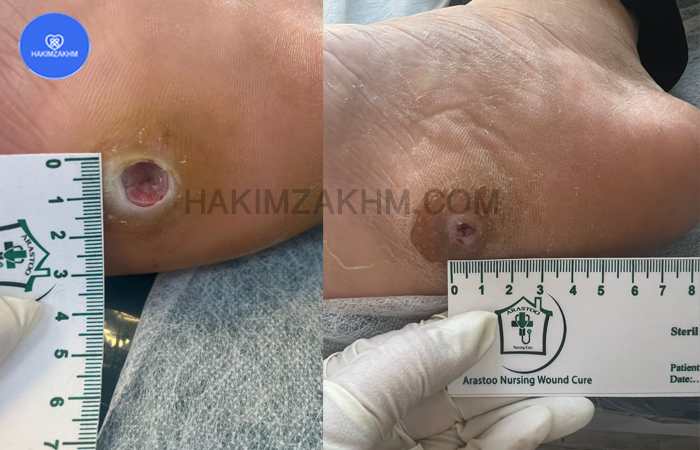 نمونه زخم انجام شده
