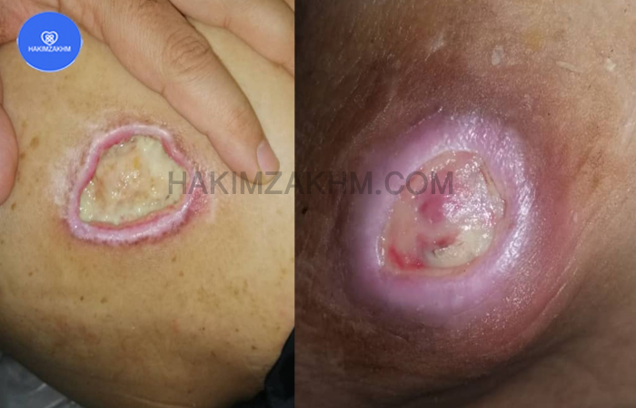 نمونه زخم انجام شده